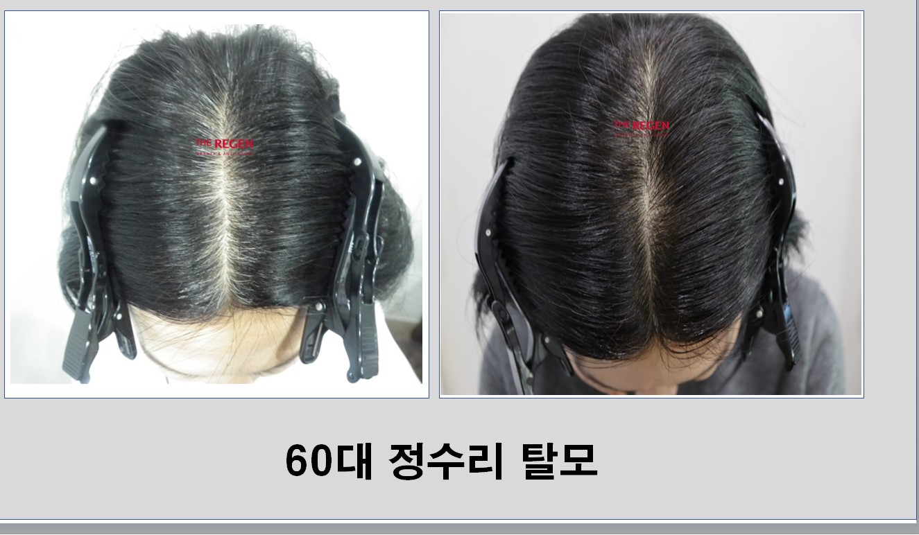60대 정수리탈모 before after